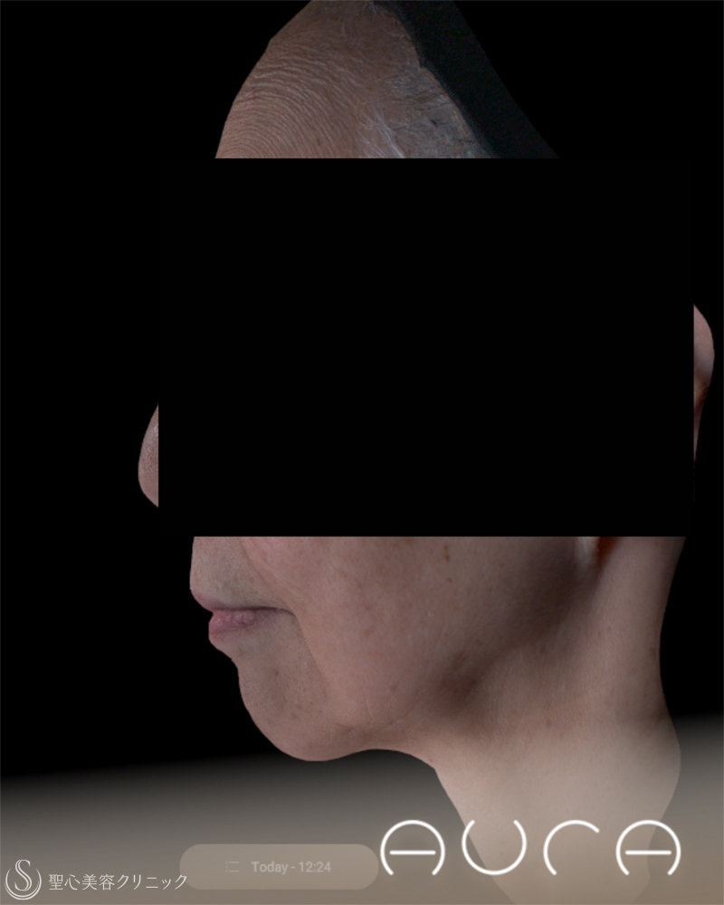 【70代女性・きれいなフェイスラインに】 ヒアルロン酸注入（2ヶ月後） After 