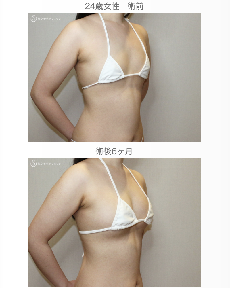 【24歳女性・脂肪幹細胞豊胸】プレミアムセリューション豊胸術（6ヶ月後） After 