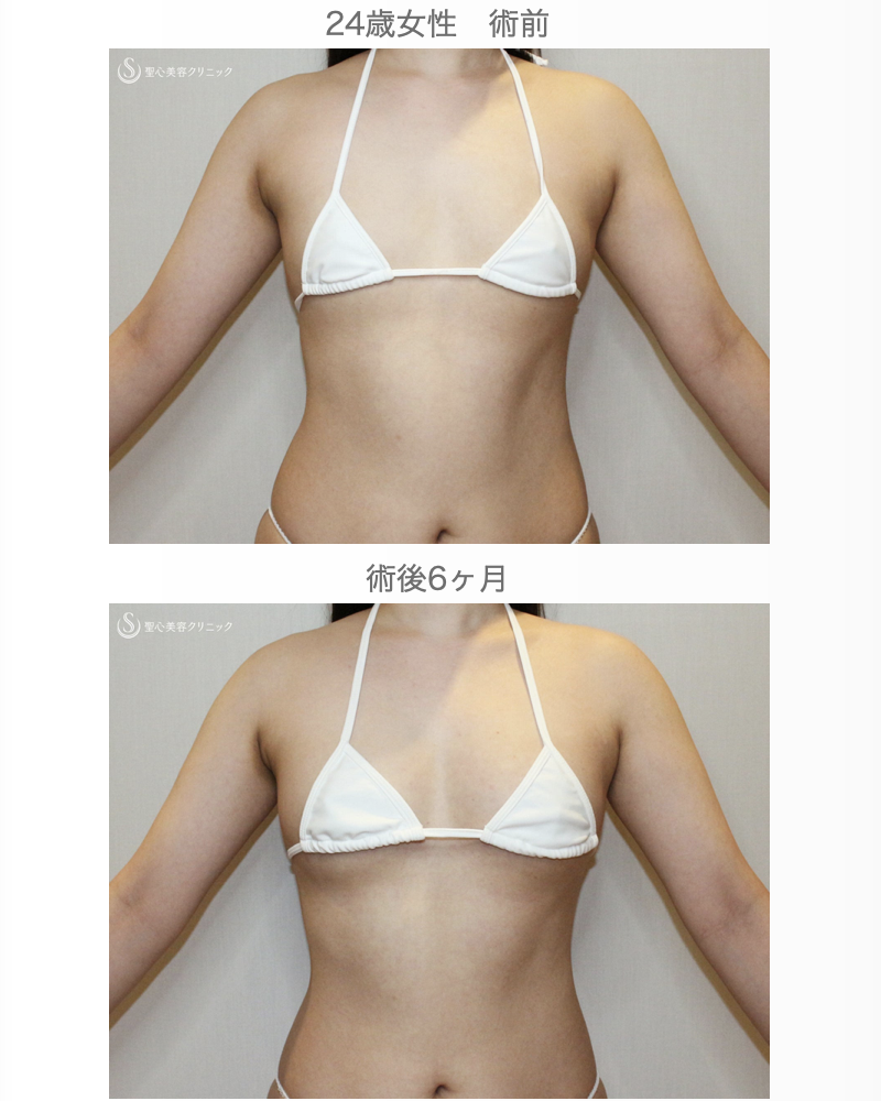 【24歳女性・脂肪幹細胞豊胸】プレミアムセリューション豊胸術（6ヶ月後） After 