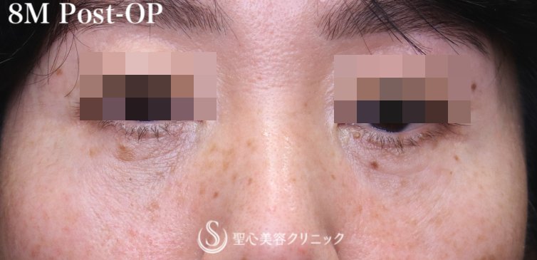 【50代女性・皮膚を切らずに目の下のたるみを改善】目の下の脂肪取り（経結膜下脱脂法）＋プレミアムPRP皮膚再生療法（目元のくぼみ・たるみ）（8ヶ月後） After 