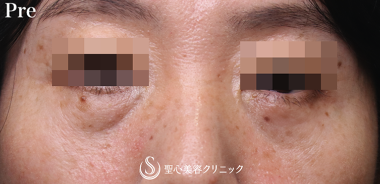 【50代女性・皮膚を切らずに目の下のたるみを改善】目の下の脂肪取り（経結膜下脱脂法）＋プレミアムPRP皮膚再生療法（目元のくぼみ・たるみ）（8ヶ月後） Before 