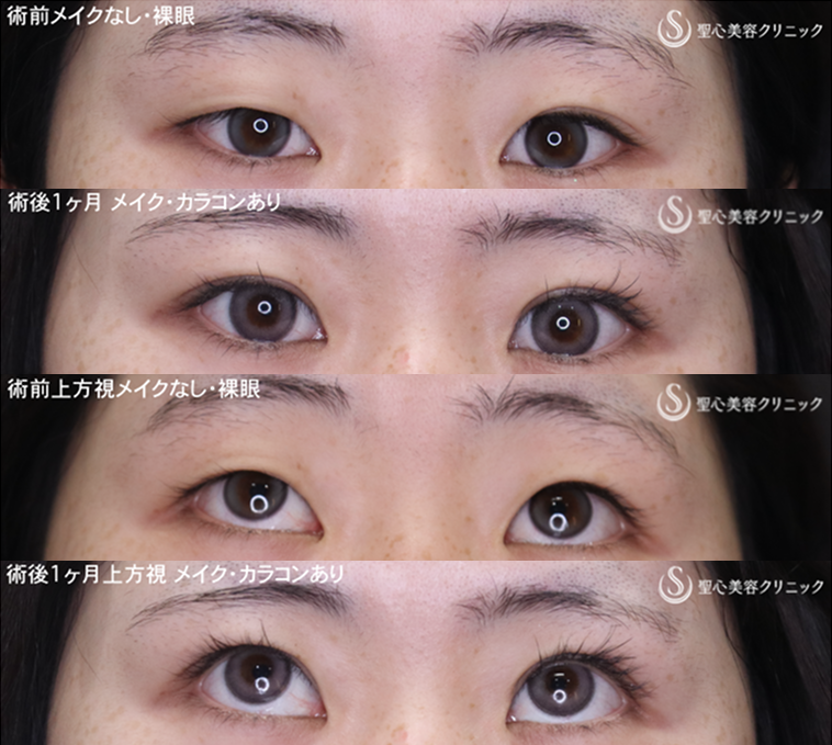 【20代女性・左右差を整えて魅力的な目元に】二重術（切開法）部分切開/全切開（1ヶ月後） After 