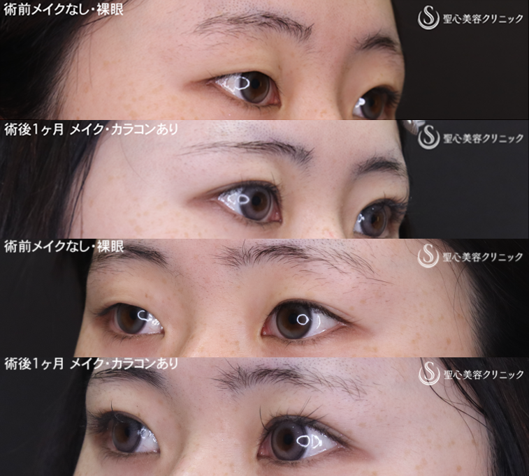 【20代女性・左右差を整えて魅力的な目元に】二重術（切開法）部分切開/全切開（1ヶ月後） After 