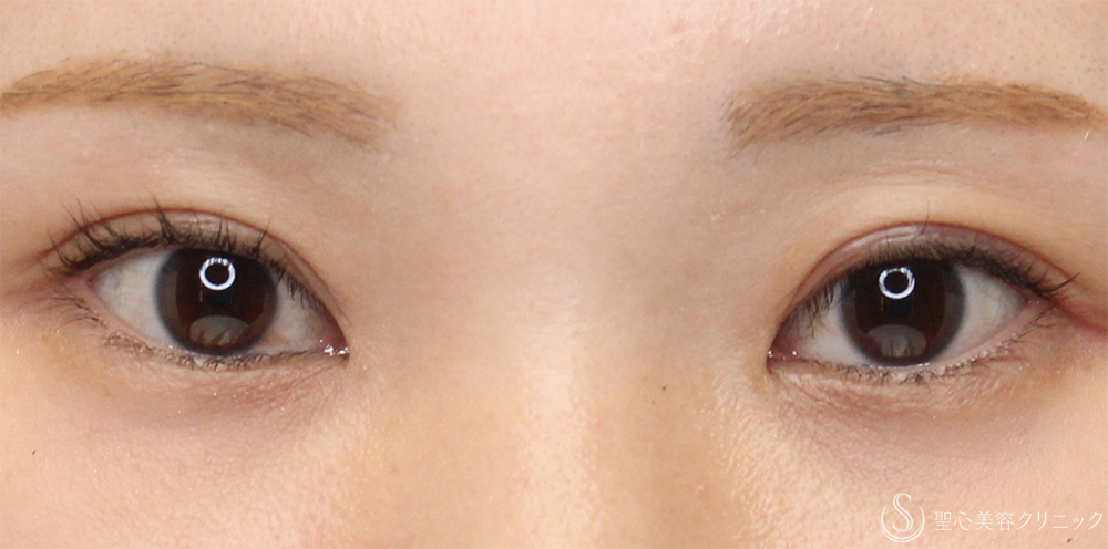 【30代女性・ハム目を改善して左右差を整えたい！！】睫毛上皮膚切開（1ヶ月後） After 