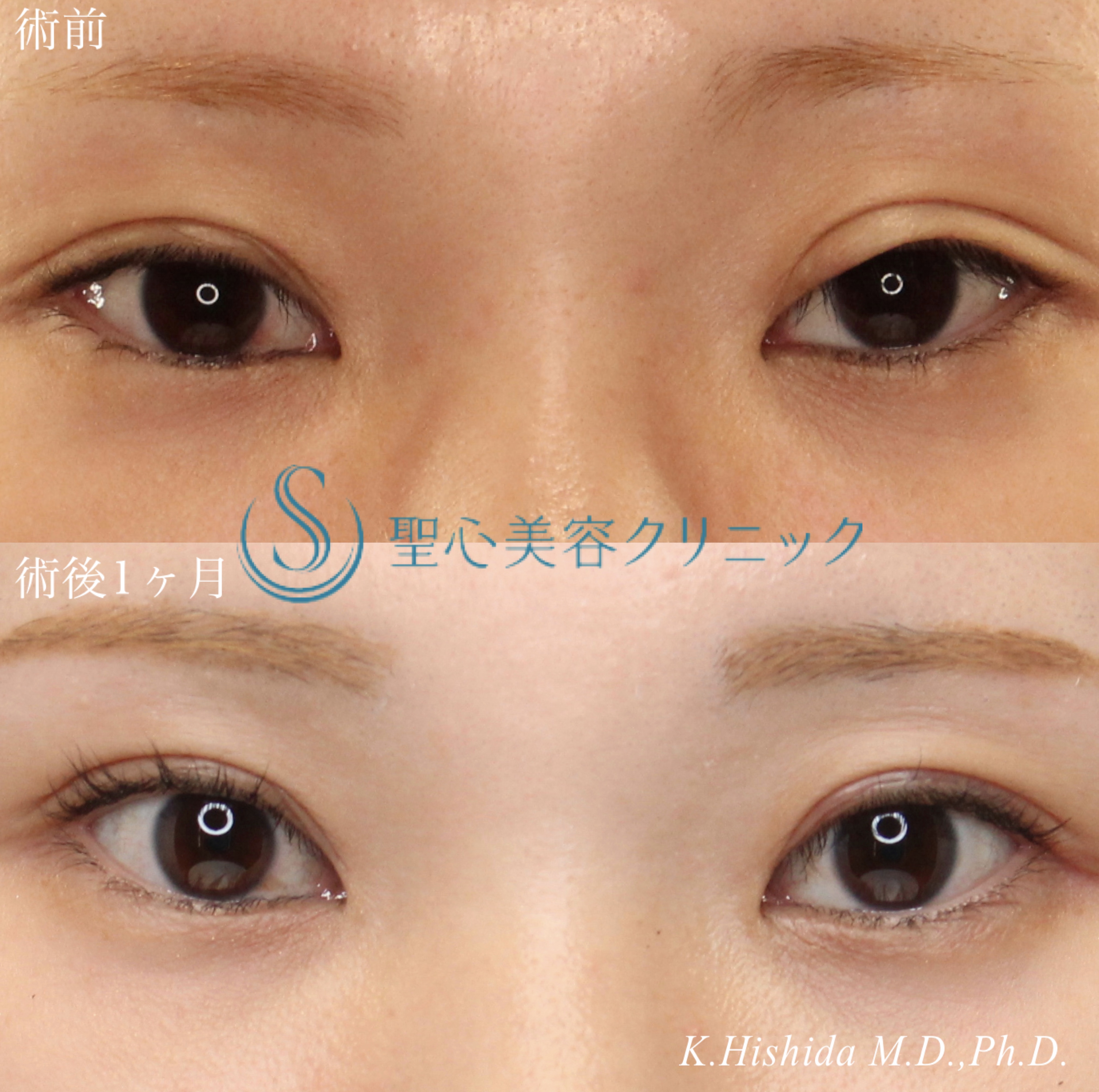【30代女性・ハム目を改善して左右差を整えたい！！】睫毛上皮膚切開（1ヶ月後） After 