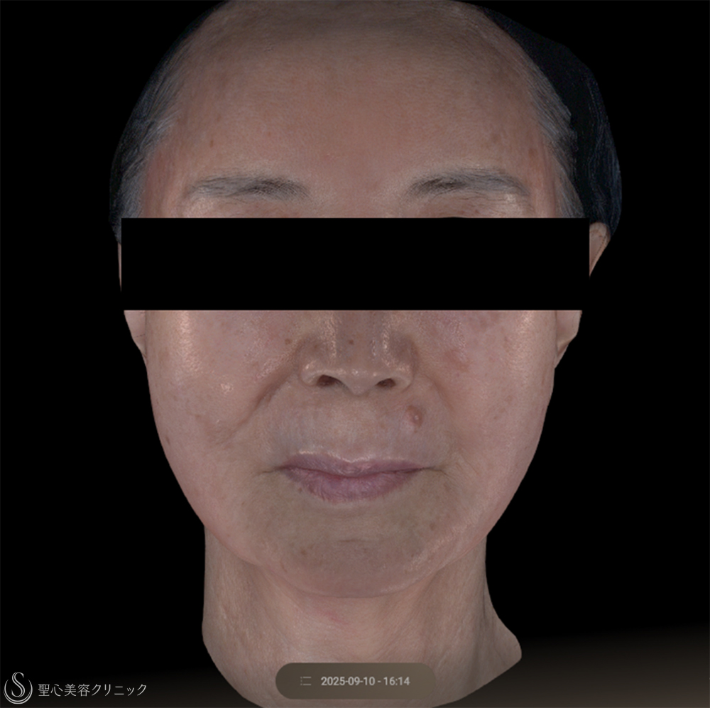 【80代女性・リフトアップ】ワンダーフェイスプロ（3回後） Before 
