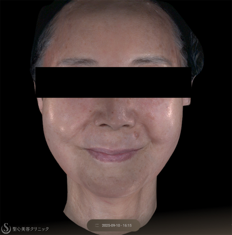 【80代女性・リフトアップ】ワンダーフェイスプロ（3回後） Before 