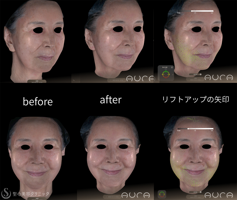 【80代女性・リフトアップ】ワンダーフェイスプロ（3回後） After 