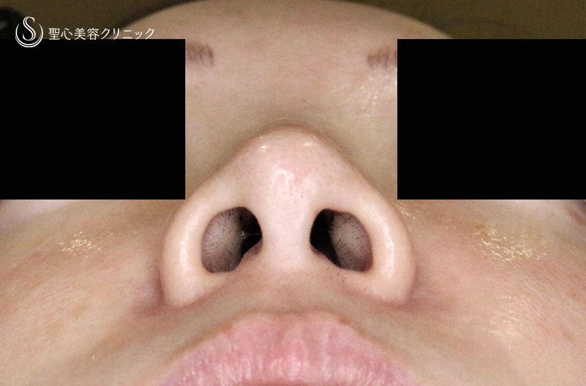 【30代女性・外側に傷をつけずに「忘れ鼻」】小鼻縮小術+α法「Ver.7.5」（術直後〜3ヶ月後） Before 