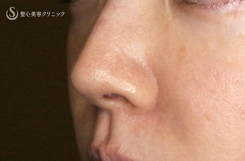 【30代女性・外側に傷をつけずに「忘れ鼻」】小鼻縮小術+α法「Ver.7.5」（術直後〜3ヶ月後） Before 