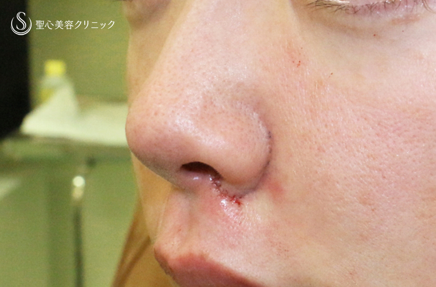 【30代女性・外側に傷をつけずに「忘れ鼻」】小鼻縮小術+α法「Ver.7.5」（術直後〜3ヶ月後） Before 