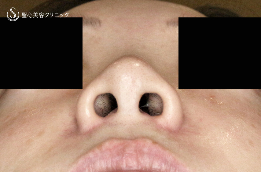 【30代女性・外側に傷をつけずに「忘れ鼻」】小鼻縮小術+α法「Ver.7.5」（術直後〜3ヶ月後） After 