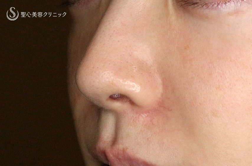 【30代女性・外側に傷をつけずに「忘れ鼻」】小鼻縮小術+α法「Ver.7.5」（術直後〜3ヶ月後） After 