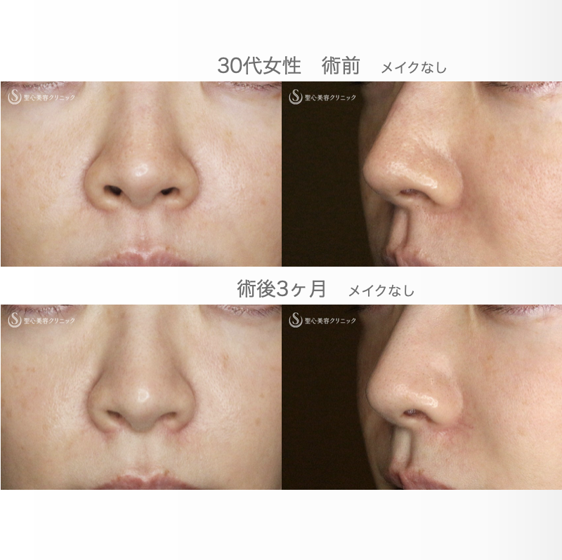 【30代女性・外側に傷をつけずに「忘れ鼻」】小鼻縮小術+α法「Ver.7.5」（術直後〜3ヶ月後） After 