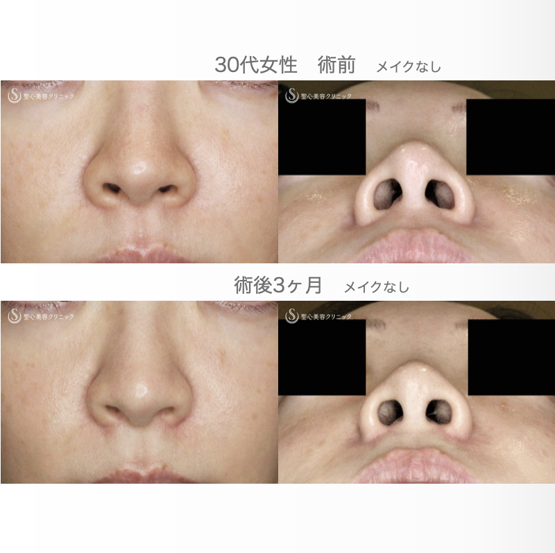 【30代女性・外側に傷をつけずに「忘れ鼻」】小鼻縮小術+α法「Ver.7.5」（術直後〜3ヶ月後） After 