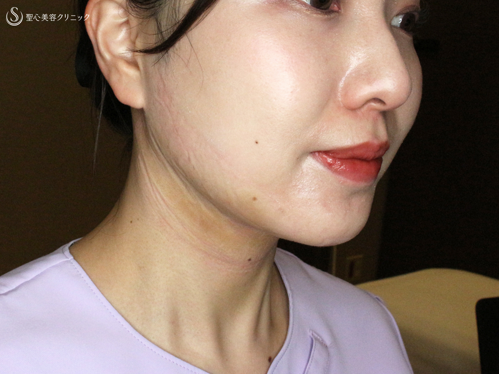 【20代女性・札幌院スタッフ】脂肪吸引注射「あご下」単独（術直後〜3ヶ月後） After 