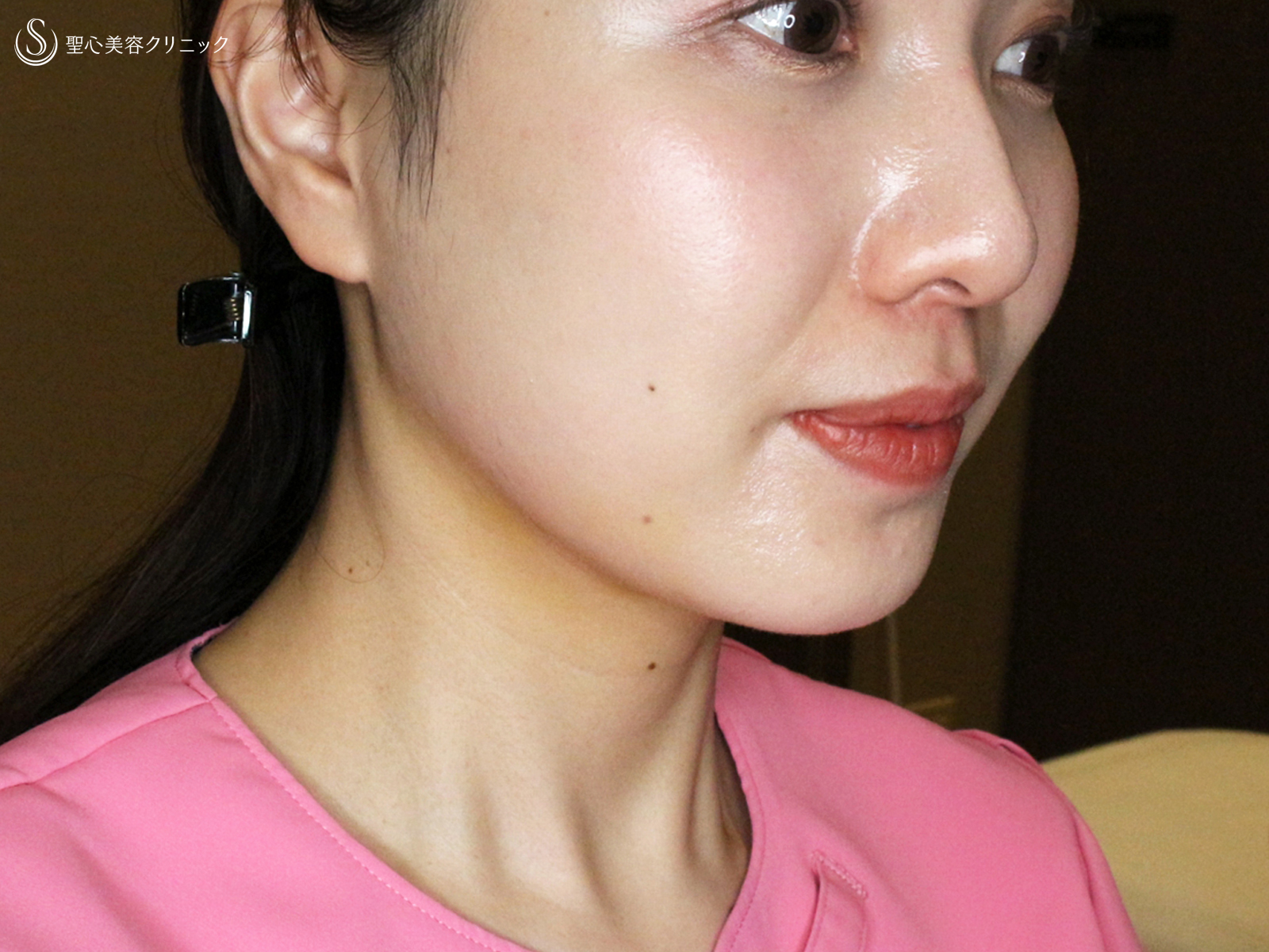 【20代女性・札幌院スタッフ】脂肪吸引注射「あご下」単独（術直後〜3ヶ月後） After 