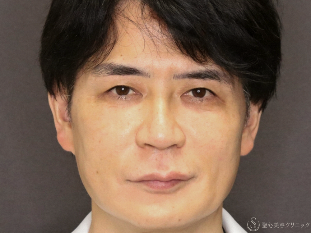 【50代男性・新しい糸リフトでフェイスラインがスッキリ】フィオラスレッドエストFL（4本）＋サポートスレッド（8本）＋Gメッシュ（4本）（2ヶ月後） Before 