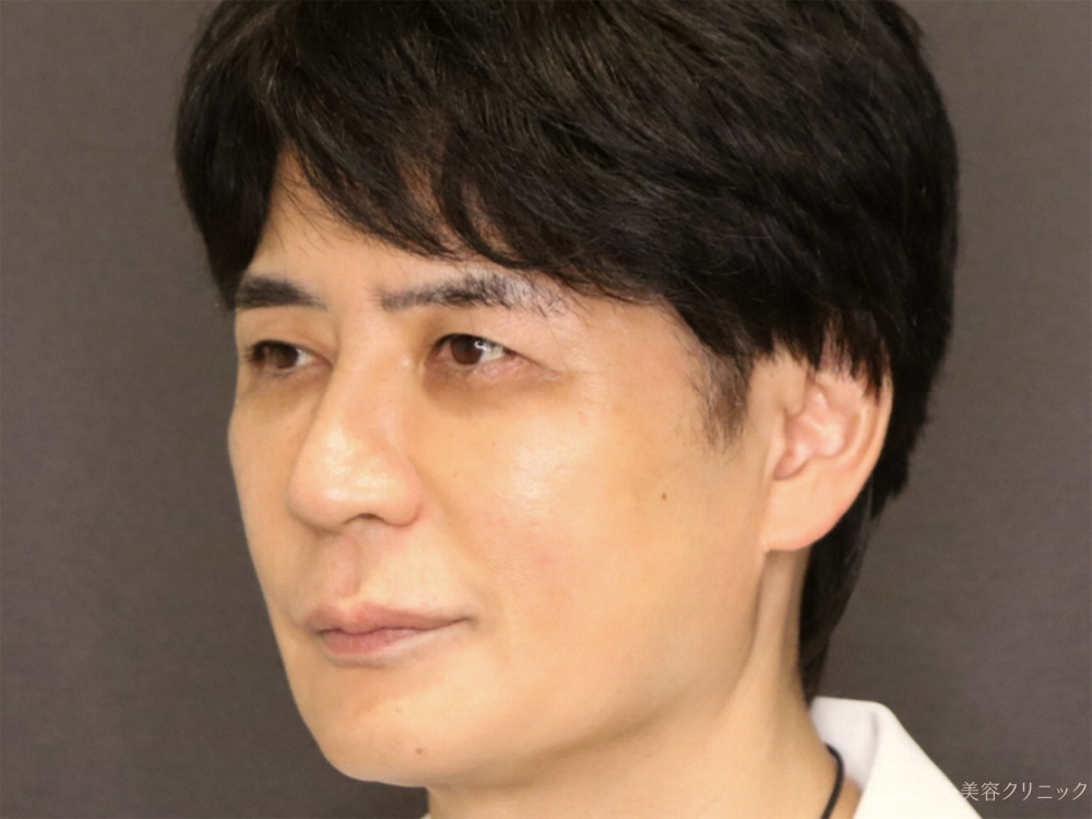 【50代男性・新しい糸リフトでフェイスラインがスッキリ】フィオラスレッドエストFL（4本）＋サポートスレッド（8本）＋Gメッシュ（4本）（2ヶ月後） Before 