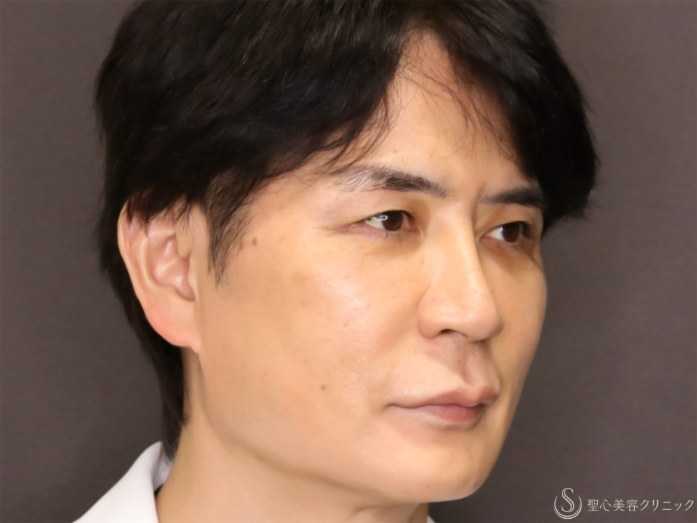 【50代男性・新しい糸リフトでフェイスラインがスッキリ】フィオラスレッドエストFL（4本）＋サポートスレッド（8本）＋Gメッシュ（4本）（2ヶ月後） Before 