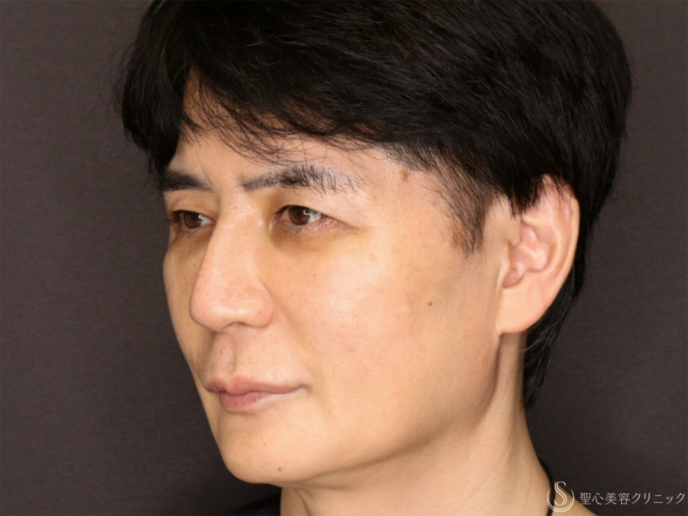 【50代男性・新しい糸リフトでフェイスラインがスッキリ】フィオラスレッドエストFL（4本）＋サポートスレッド（8本）＋Gメッシュ（4本）（2ヶ月後） After 