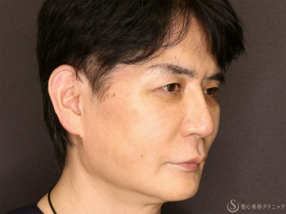 【50代男性・新しい糸リフトでフェイスラインがスッキリ】フィオラスレッドエストFL（4本）＋サポートスレッド（8本）＋Gメッシュ（4本）（2ヶ月後） After 