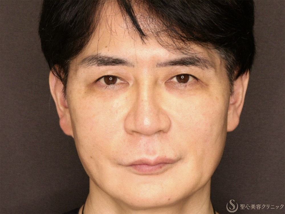 【50代男性・新しい糸リフトでフェイスラインがスッキリ】フィオラスレッドエストFL（4本）＋サポートスレッド（8本）＋Gメッシュ（4本）（2ヶ月後） After 