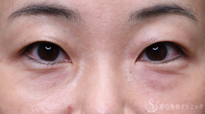 【40代女性・目の下ハイフでたるみ改善】眼窩脂肪（目の下）ハイフ（術直後） After