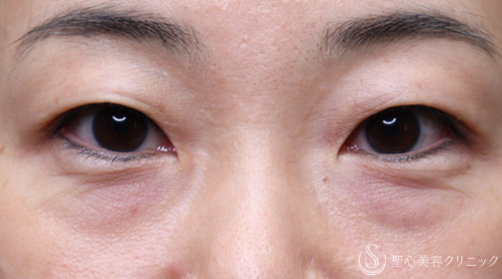 【40代女性・目の下ハイフでたるみ改善】眼窩脂肪（目の下）ハイフ（術直後） Before