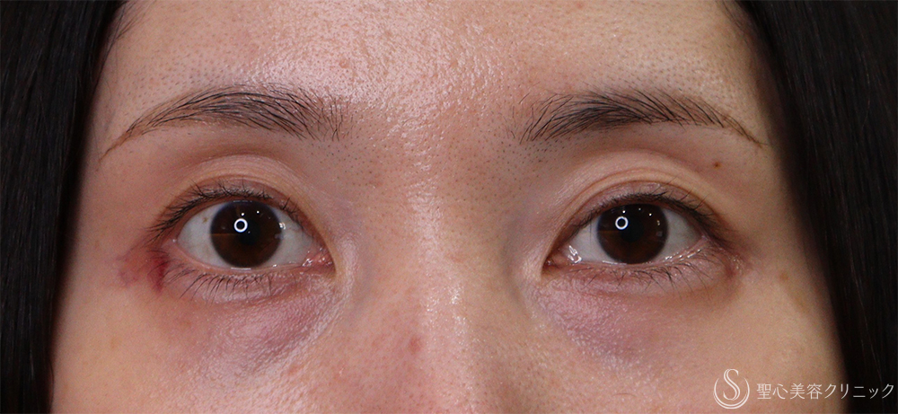 【40代女性・目の周りのくぼみ】プレミアムPRP皮膚再生療法（6ヶ月後） Before 