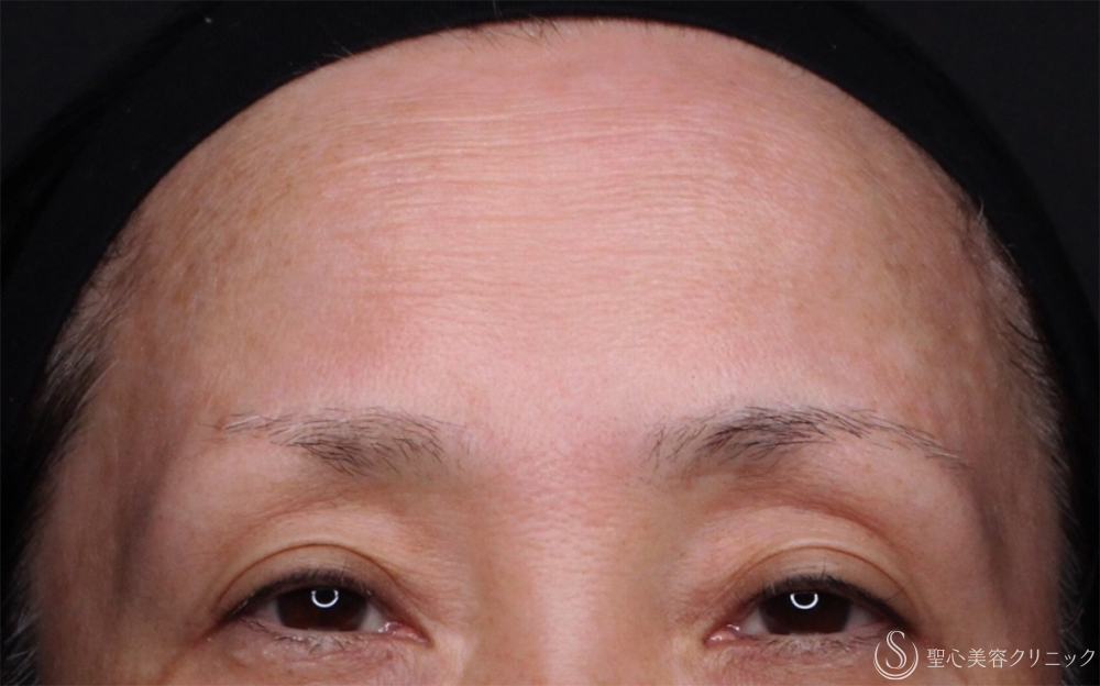 【50代女性・額とこめかみの凹み】プレミアムPRP皮膚再生療法（3ヶ月後） Before 
