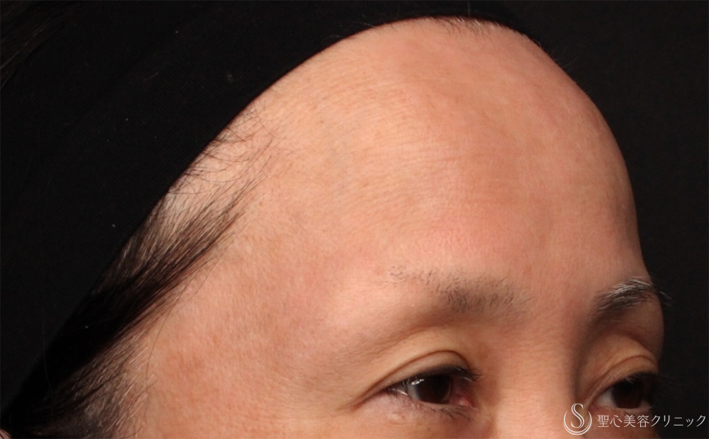 【50代女性・額とこめかみの凹み】プレミアムPRP皮膚再生療法（3ヶ月後） Before 