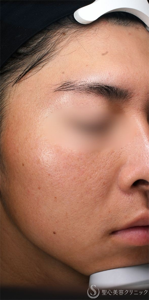 【20代男性・肌質改善】POTENZA（ポテンツァ）_毛穴＋ポゼラン導入（1ヶ月後） Before 名古屋+ポテンツァ・肌育・毛穴