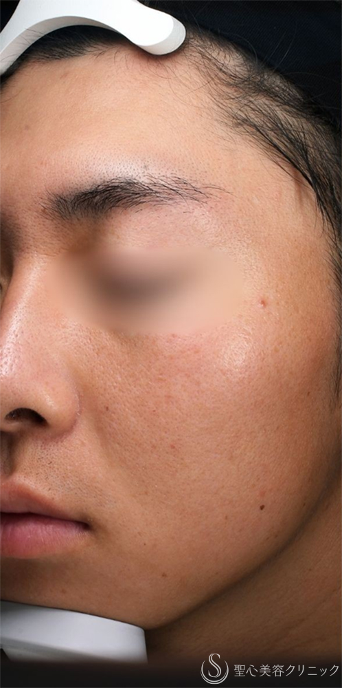 【20代男性・肌質改善】POTENZA（ポテンツァ）_毛穴＋ポゼラン導入（1ヶ月後） Before 名古屋+ポテンツァ・肌育・毛穴