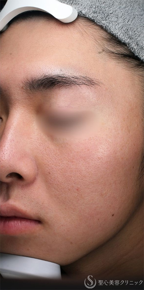 【20代男性・肌質改善】POTENZA（ポテンツァ）_毛穴＋ポゼラン導入（1ヶ月後） After 名古屋+ポテンツァ・肌育・毛穴