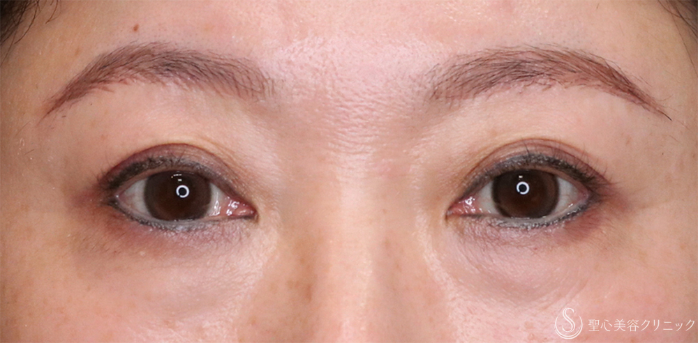【40代女性・まぶたすっきり】眉下切開法（眉下リフト）（1年後） After 名古屋・まぶたのタルミ取り・二重・ぱっちり二重・眉下切開
