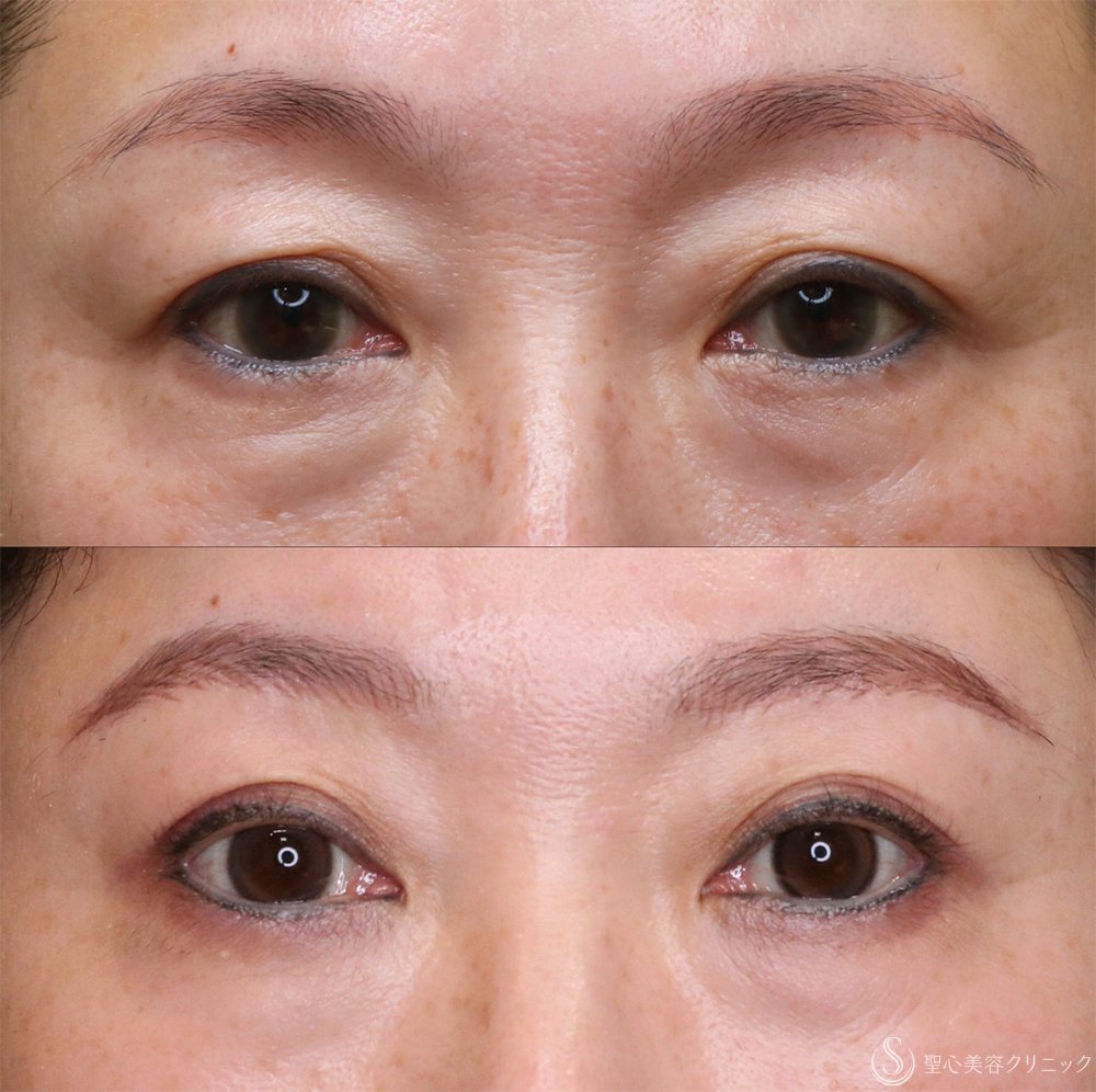 【40代女性・まぶたすっきり】眉下切開法（眉下リフト）（1年後） After 名古屋・まぶたのタルミ取り・二重・ぱっちり二重・眉下切開