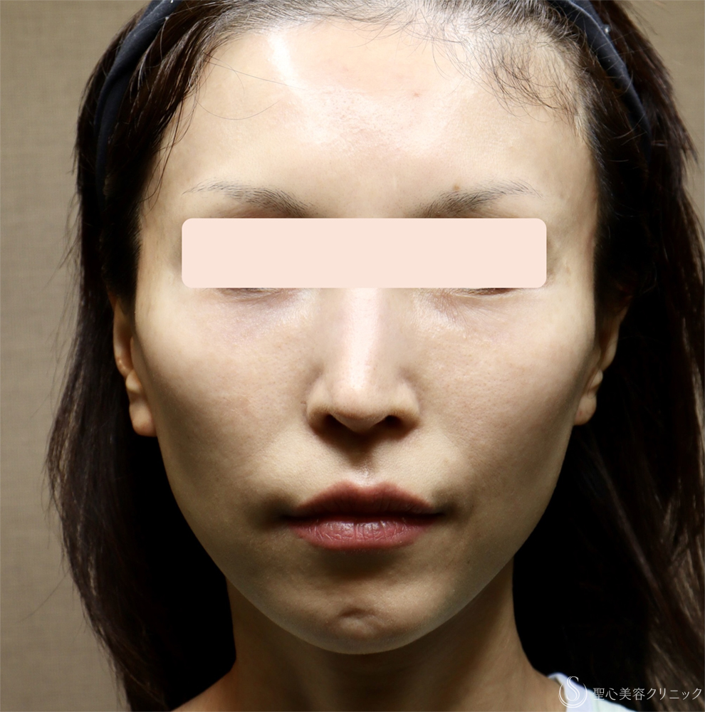 【40代女性・顔の弛み】エクステンデッドディーププレーンフェイスリフト（1週間後） Before 