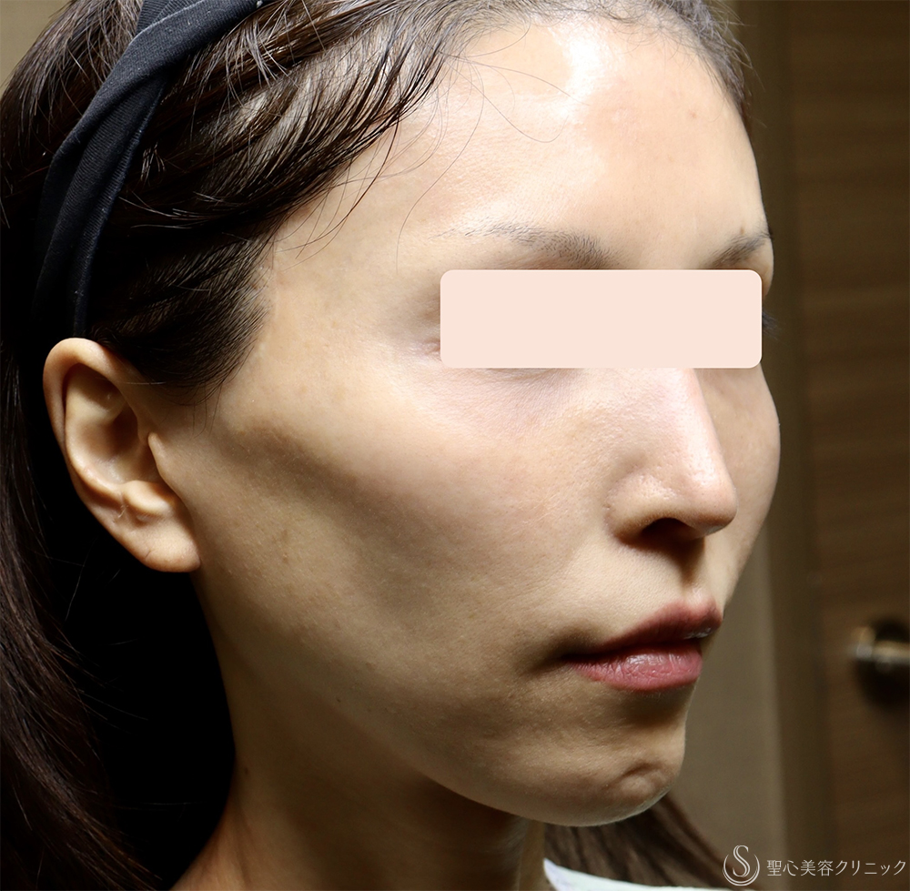 【40代女性・顔の弛み】エクステンデッドディーププレーンフェイスリフト（1週間後） Before 