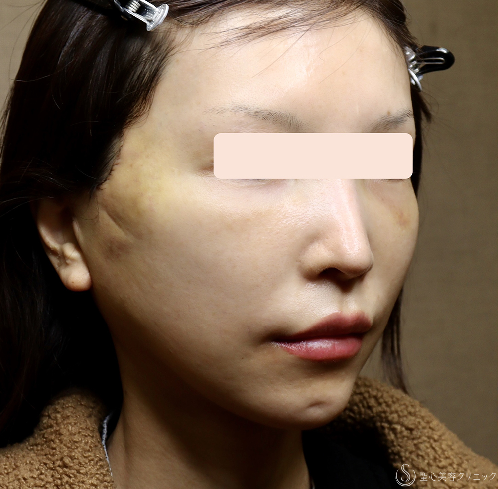 【40代女性・顔の弛み】エクステンデッドディーププレーンフェイスリフト（1週間後） After 