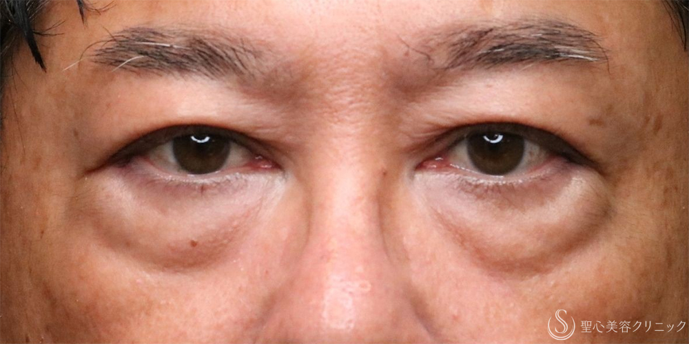 【60代男性・目の下すっきり】目の下のたるみ取り（1ヶ月後） Before 名古屋+目の下のくま・くまとり