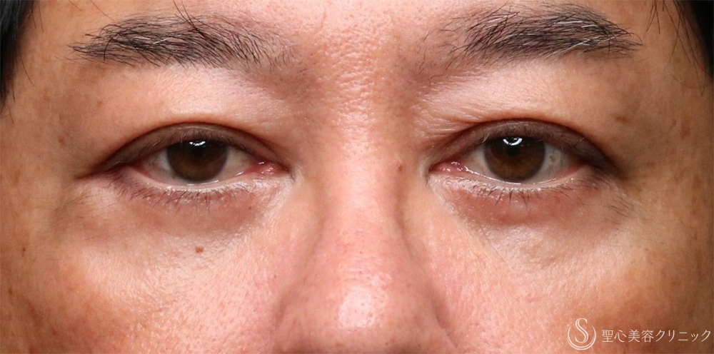 【60代男性・目の下すっきり】目の下のたるみ取り（1ヶ月後） After 名古屋+目の下のくま・くまとり