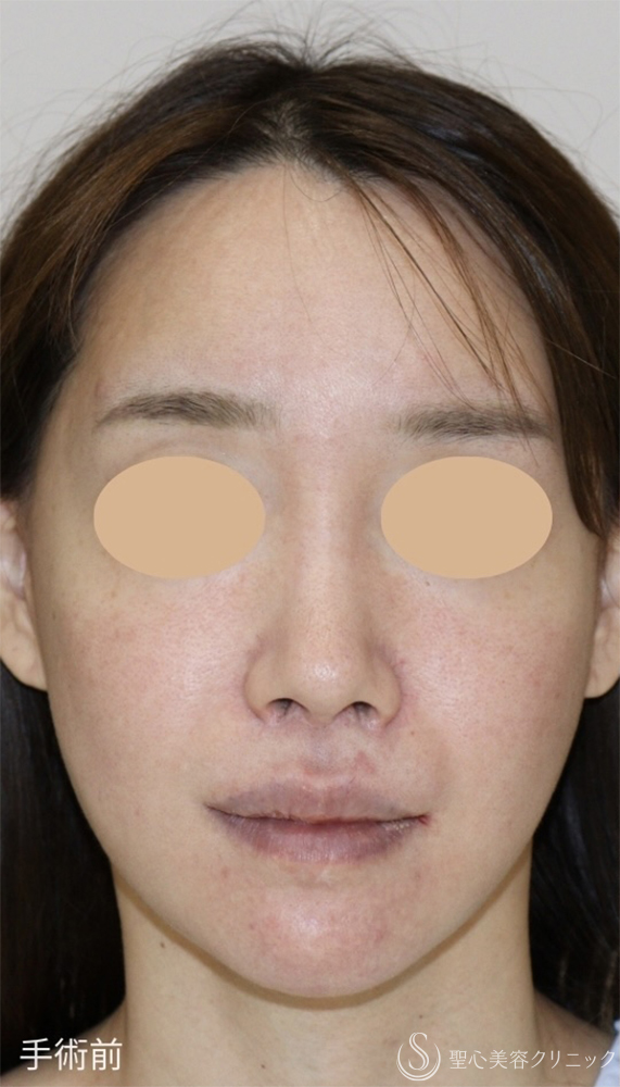 【30代女性・失われた構造を取り戻し、上品な“自然鼻”へ】鼻下短縮術（人中短縮）（1週間後） Before 