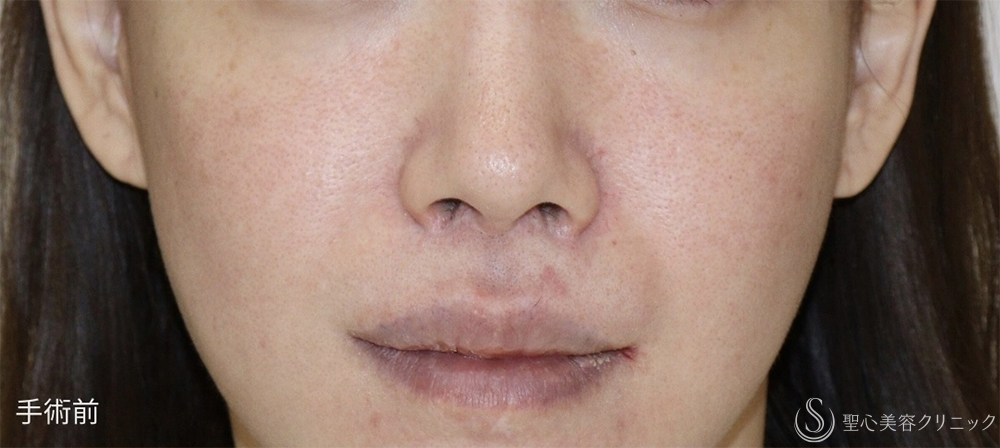 【30代女性・失われた構造を取り戻し、上品な“自然鼻”へ】鼻下短縮術（人中短縮）（1週間後） Before 