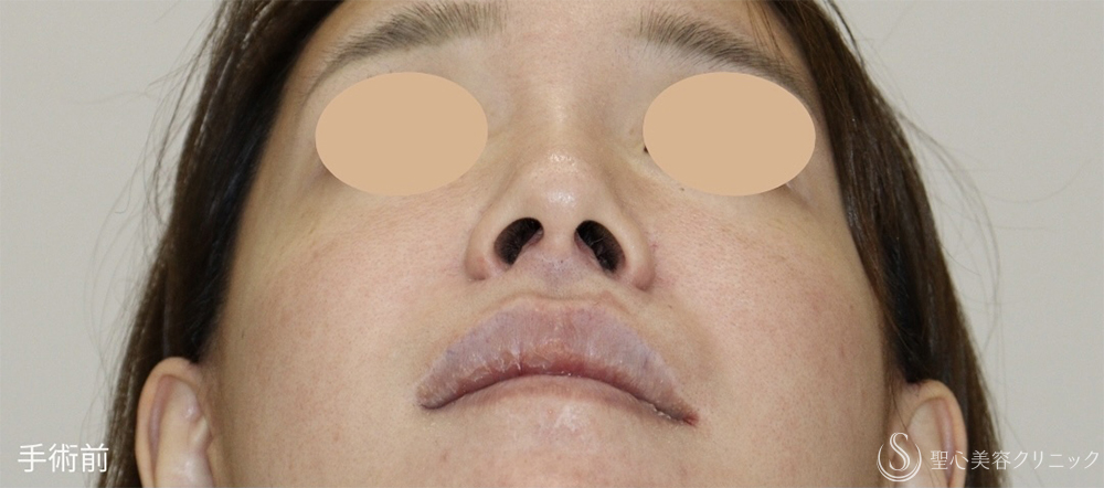 【30代女性・失われた構造を取り戻し、上品な“自然鼻”へ】鼻下短縮術（人中短縮）（1週間後） Before 