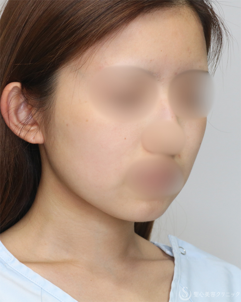 【20代女性・シャープで整った小顔】脂肪吸引（頬・顎下）（2年後） Before 