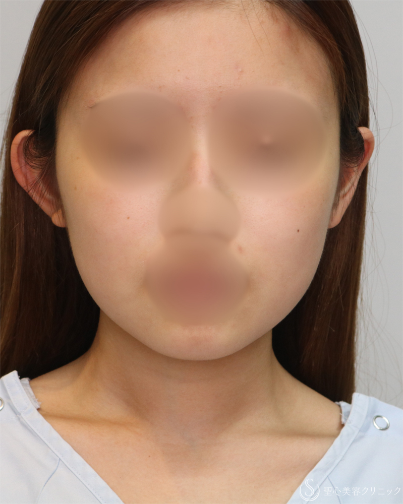 【20代女性・シャープで整った小顔】脂肪吸引（頬・顎下）（2年後） Before 