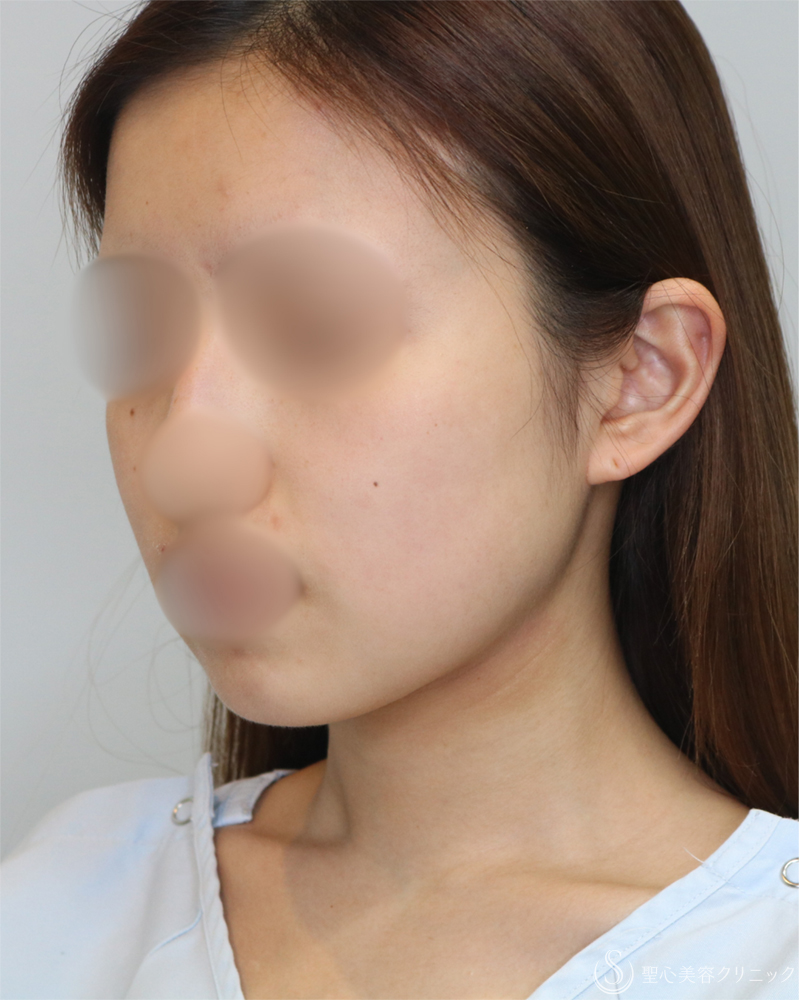 【20代女性・シャープで整った小顔】脂肪吸引（頬・顎下）（2年後） Before 