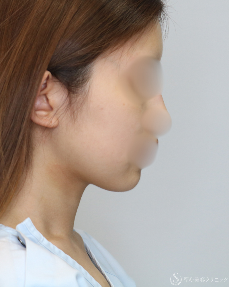 【20代女性・シャープで整った小顔】脂肪吸引（頬・顎下）（2年後） Before 
