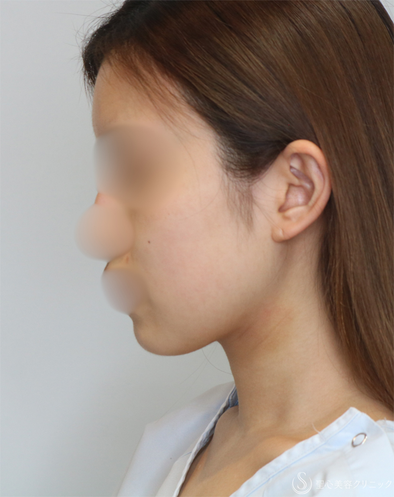 【20代女性・シャープで整った小顔】脂肪吸引（頬・顎下）（2年後） Before 
